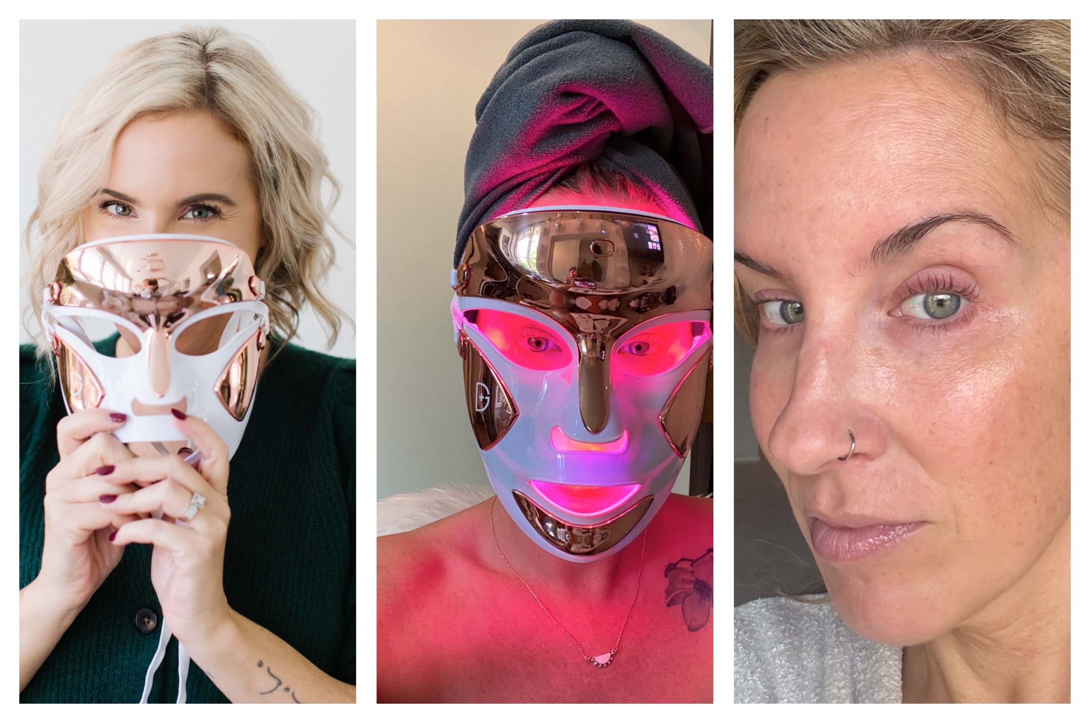 Dr. Dennis Gross LED Masks: Actual Outcomes At 3 Months & 5 Years